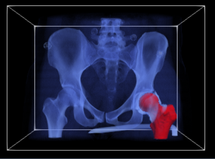 Graphic of mesh based femur use case